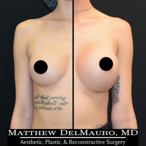 P16-Before-After-4.5-Months-–-Breast-Augmentation-Silicone1