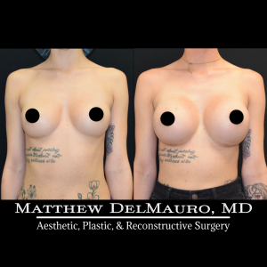 P16-Before-After-4.5-Months-–-Breast-Augmentation-Silicone2