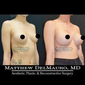 P16-Before-After-4.5-Months-–-Breast-Augmentation-Silicone3