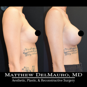 P16-Before-After-4.5-Months-–-Breast-Augmentation-Silicone4