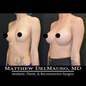 P16-Before-After-4.5-Months-–-Breast-Augmentation-Silicone6