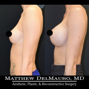 P16-Before-After-4.5-Months-–-Breast-Augmentation-Silicone7