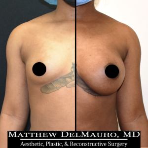 P18-Before-After-4-Months-–-Breast-Augmentation-Silicone1