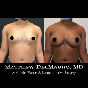 P18-Before-After-4-Months-–-Breast-Augmentation-Silicone2