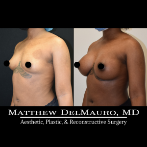 P18-Before-After-4-Months-–-Breast-Augmentation-Silicone3