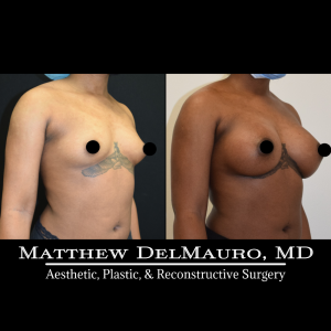 P18-Before-After-4-Months-–-Breast-Augmentation-Silicone4