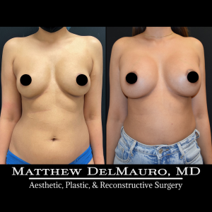 P2-Before-After-4-Months-–-Breast-Augmentation-Silicone1