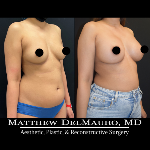 P2-Before-After-4-Months-–-Breast-Augmentation-Silicone2