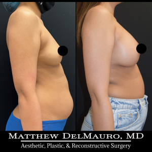 P2-Before-After-4-Months-–-Breast-Augmentation-Silicone3