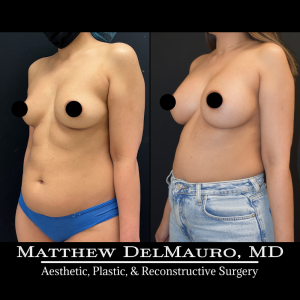 P2-Before-After-4-Months-–-Breast-Augmentation-Silicone4