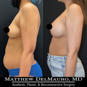 P2-Before-After-4-Months-–-Breast-Augmentation-Silicone5