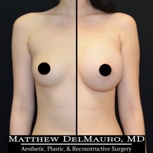 P23-Before-After-5-Months-–-Breast-Augmentation-Silicone1