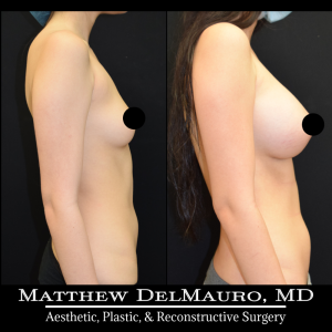 P23-Before-After-5-Months-–-Breast-Augmentation-Silicone3