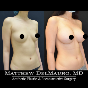 P23-Before-After-5-Months-–-Breast-Augmentation-Silicone4