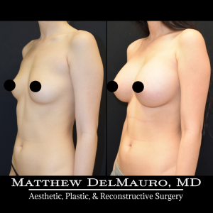 P23-Before-After-5-Months-–-Breast-Augmentation-Silicone5