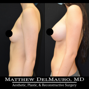 P23-Before-After-5-Months-–-Breast-Augmentation-Silicone6