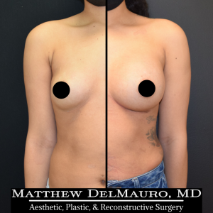 P27-Before-After-1-Months-–-Breast-Augmentation-Silicone1