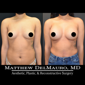 P27-Before-After-1-Months-–-Breast-Augmentation-Silicone2