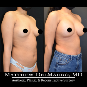 P27-Before-After-1-Months-–-Breast-Augmentation-Silicone3