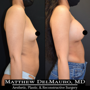 P27-Before-After-1-Months-–-Breast-Augmentation-Silicone4