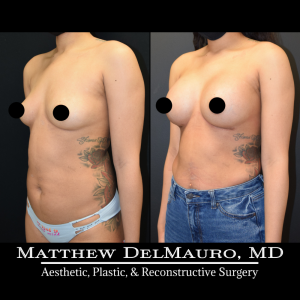 P27-Before-After-1-Months-–-Breast-Augmentation-Silicone5