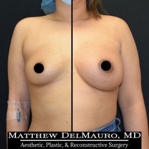 P28-Before-After-4-Months-–-Breast-Augmentation-Silicone1