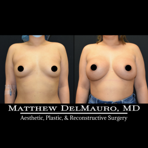 P28-Before-After-4-Months-–-Breast-Augmentation-Silicone2