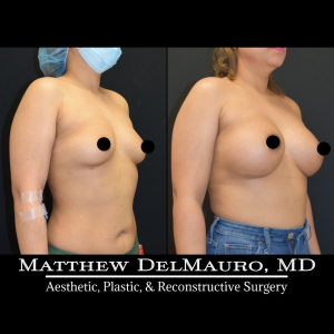 P28-Before-After-4-Months-–-Breast-Augmentation-Silicone3