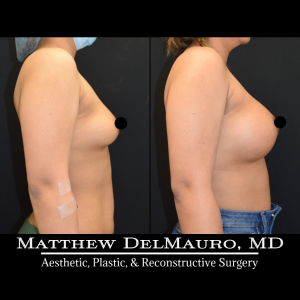 P28-Before-After-4-Months-–-Breast-Augmentation-Silicone4