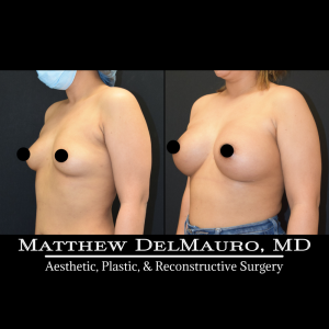 P28-Before-After-4-Months-–-Breast-Augmentation-Silicone5