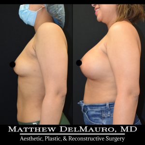 P28-Before-After-4-Months-–-Breast-Augmentation-Silicone6