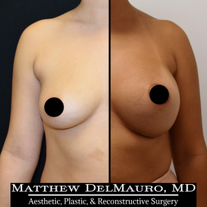 P29-Before-After-3-Months-–-Breast-Augmentation-Silicone1