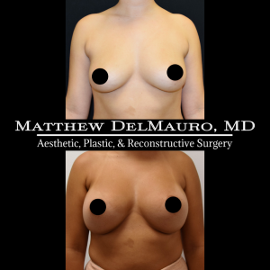 P29-Before-After-3-Months-–-Breast-Augmentation-Silicone2