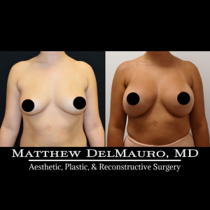 P29-Before-After-3-Months-–-Breast-Augmentation-Silicone3