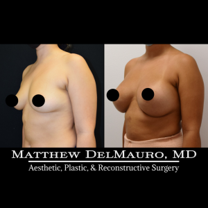 P29-Before-After-3-Months-–-Breast-Augmentation-Silicone4