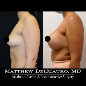 P29-Before-After-3-Months-–-Breast-Augmentation-Silicone5