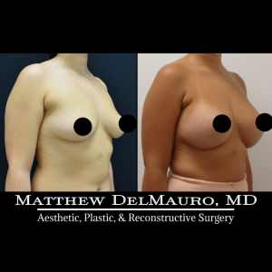 P29-Before-After-3-Months-–-Breast-Augmentation-Silicone6