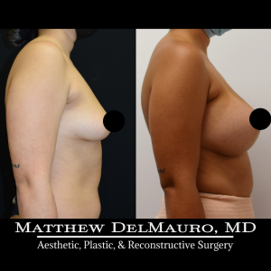 P29-Before-After-3-Months-–-Breast-Augmentation-Silicone7