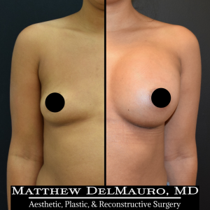 P31-Before-After-1-Months-Breast-Augmentation-Silicone1