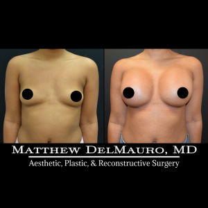 P31-Before-After-1-Months-Breast-Augmentation-Silicone2