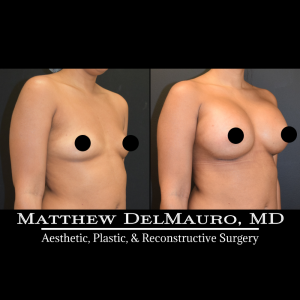 P31-Before-After-1-Months-Breast-Augmentation-Silicone3