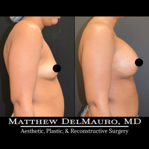 P31-Before-After-1-Months-Breast-Augmentation-Silicone4