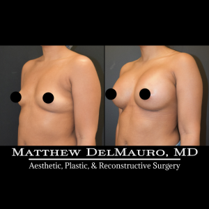 P31-Before-After-1-Months-Breast-Augmentation-Silicone5