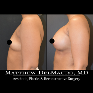 P31-Before-After-1-Months-Breast-Augmentation-Silicone6