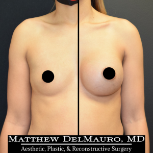 P32-Before-After-3-Months-–-Breast-Augmentation-Silicone1