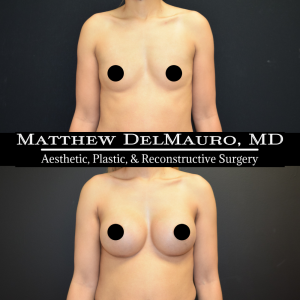 P32-Before-After-3-Months-–-Breast-Augmentation-Silicone2