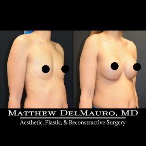 P32-Before-After-3-Months-–-Breast-Augmentation-Silicone3