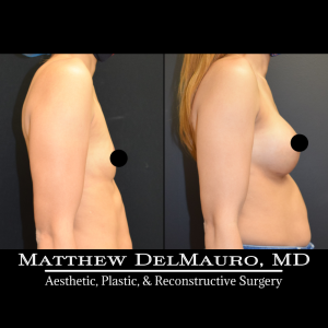 P32-Before-After-3-Months-–-Breast-Augmentation-Silicone4