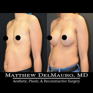 P32-Before-After-3-Months-–-Breast-Augmentation-Silicone5