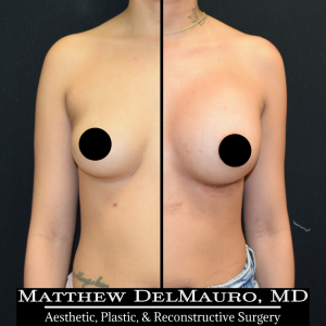 P33-Before-After-1-Months-–-Breast-Augmentation-Silicone1